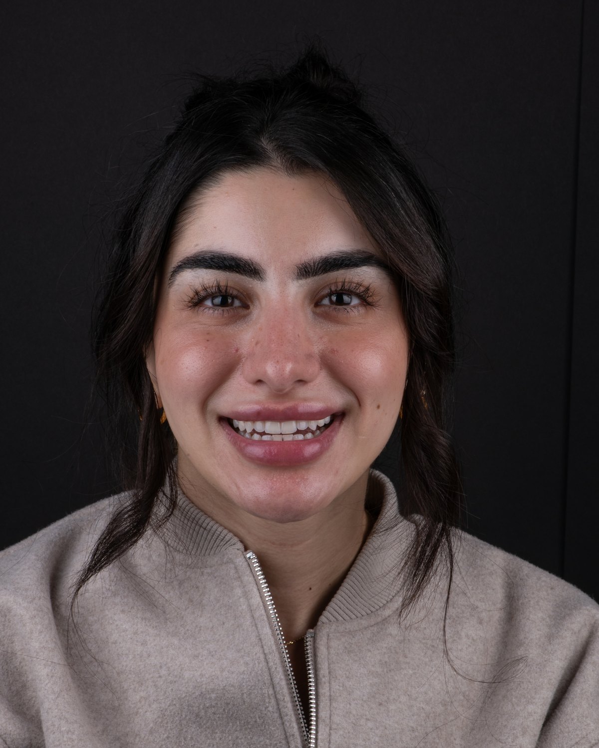 Patient before Printed PERL Veneer treatment, showing natural tooth color and uneven proportions