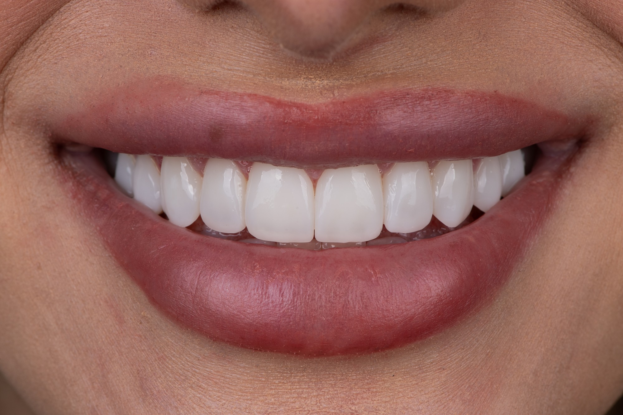 A close-up of a patient's finished Printed PERL Veneer smile at Smile On Nashville