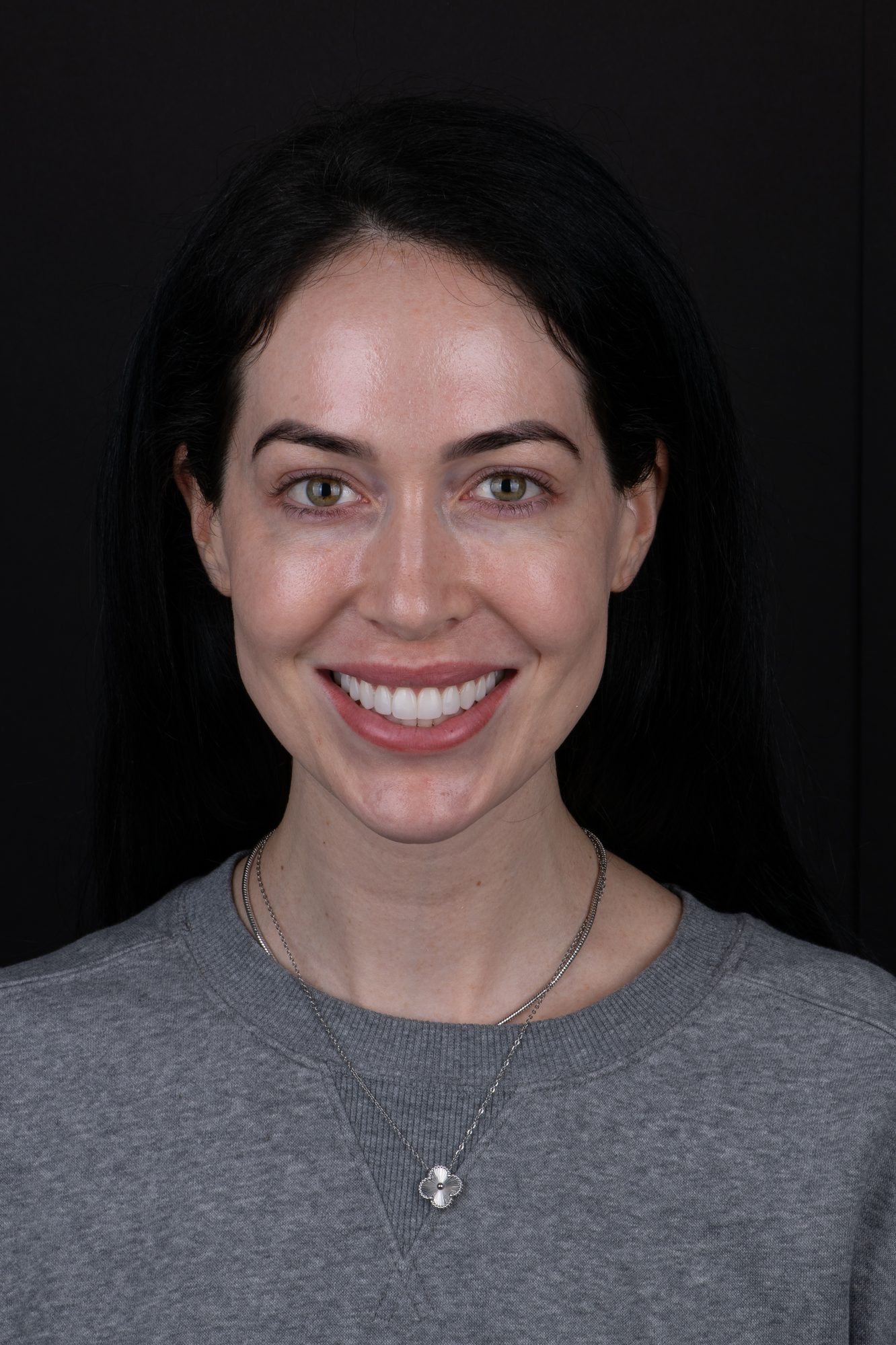 A real Smile On Nashville patient
