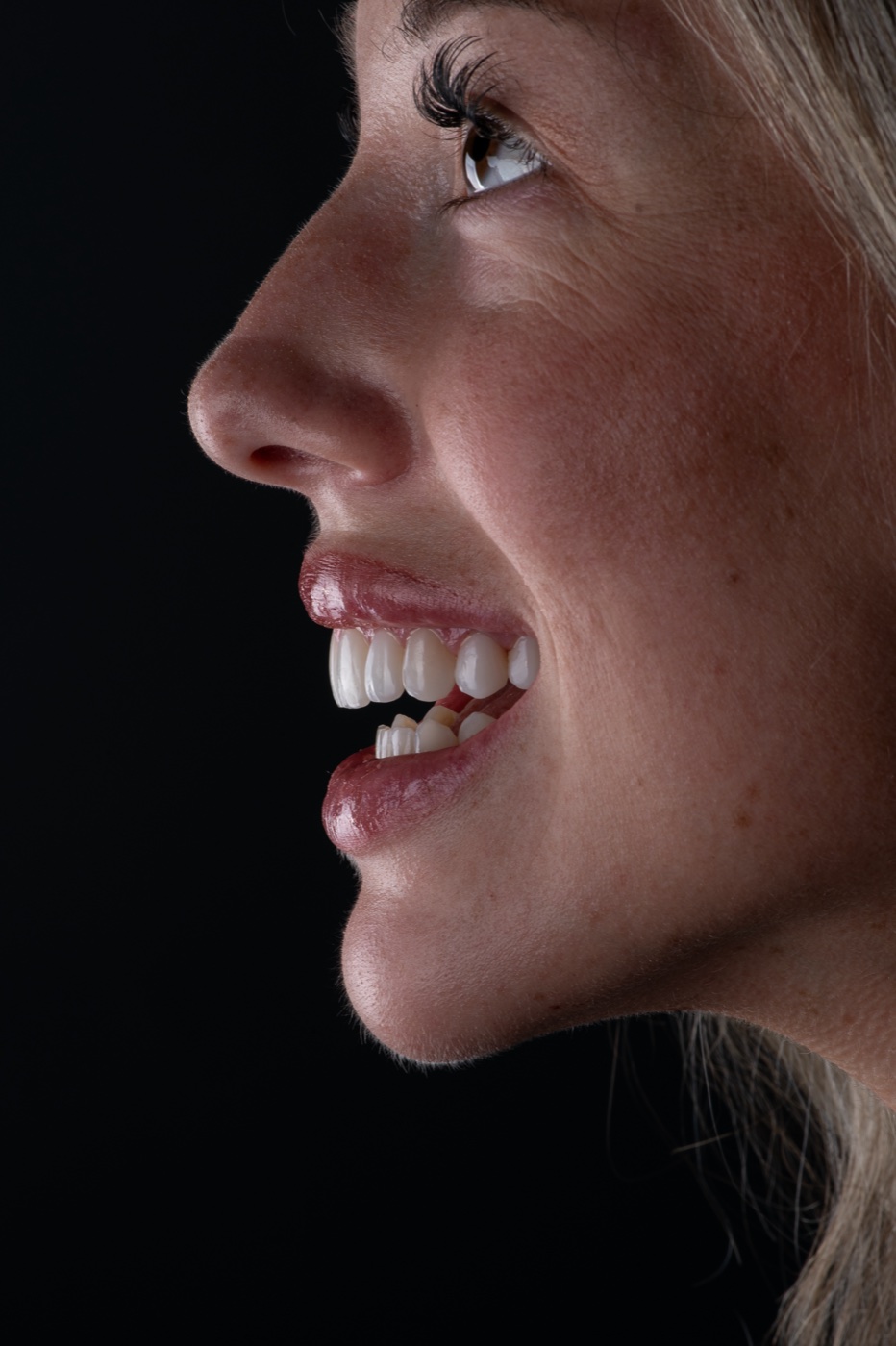Profile of a patient's finished smile against a dark backdrop