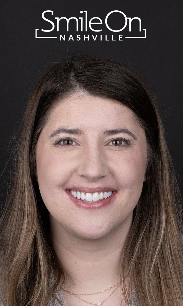 A Smile On Nashville patient smiling after her Printed PERL Veneer makeover
