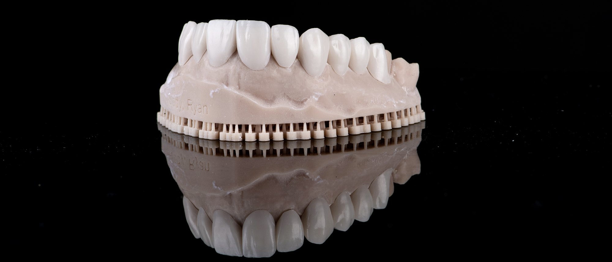 A finished PERL veneer arch, printed at Smile On Nashville