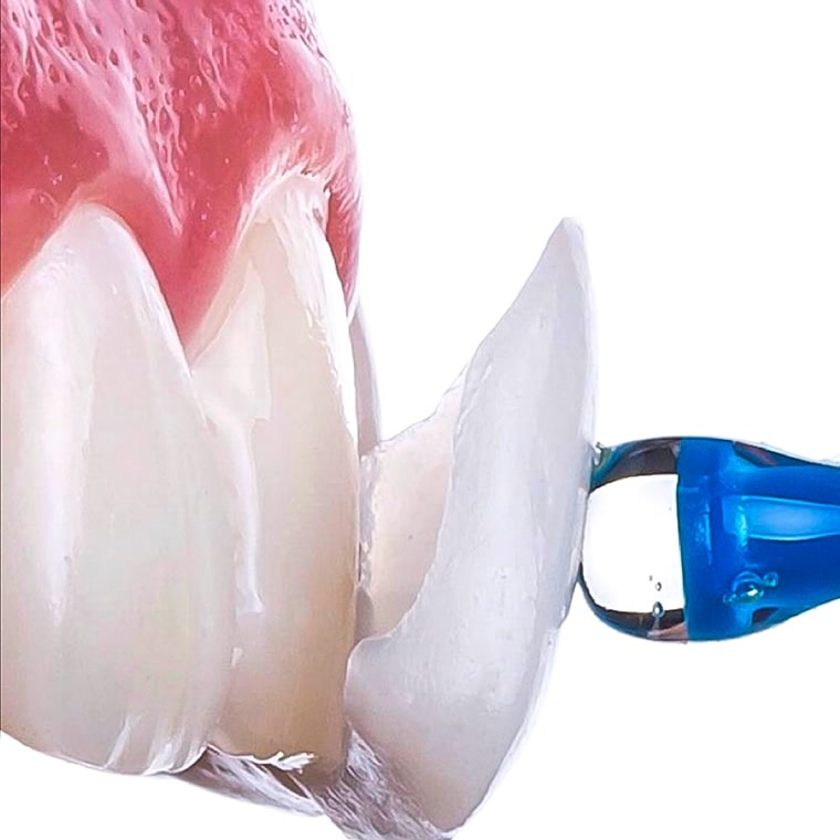Veneer on a blue applicator with a bonding drop