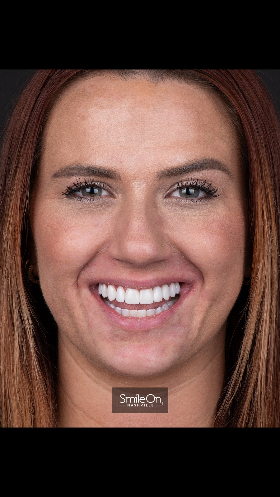 Patient smile portrait after conservative cosmetic treatment, with even color and corrected proportions