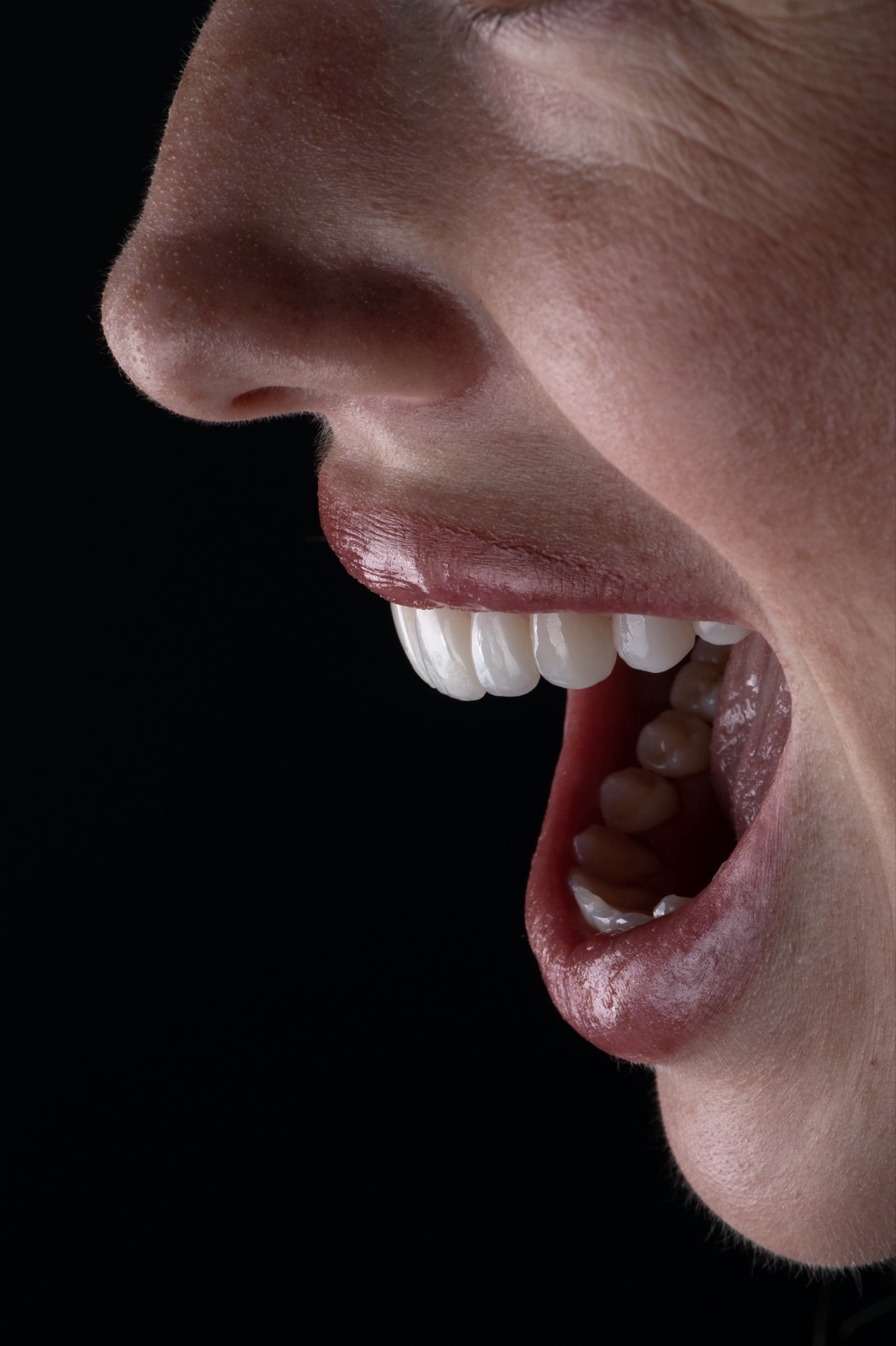 Patient smile after a non-invasive PERL veneer makeover at Smile On Nashville