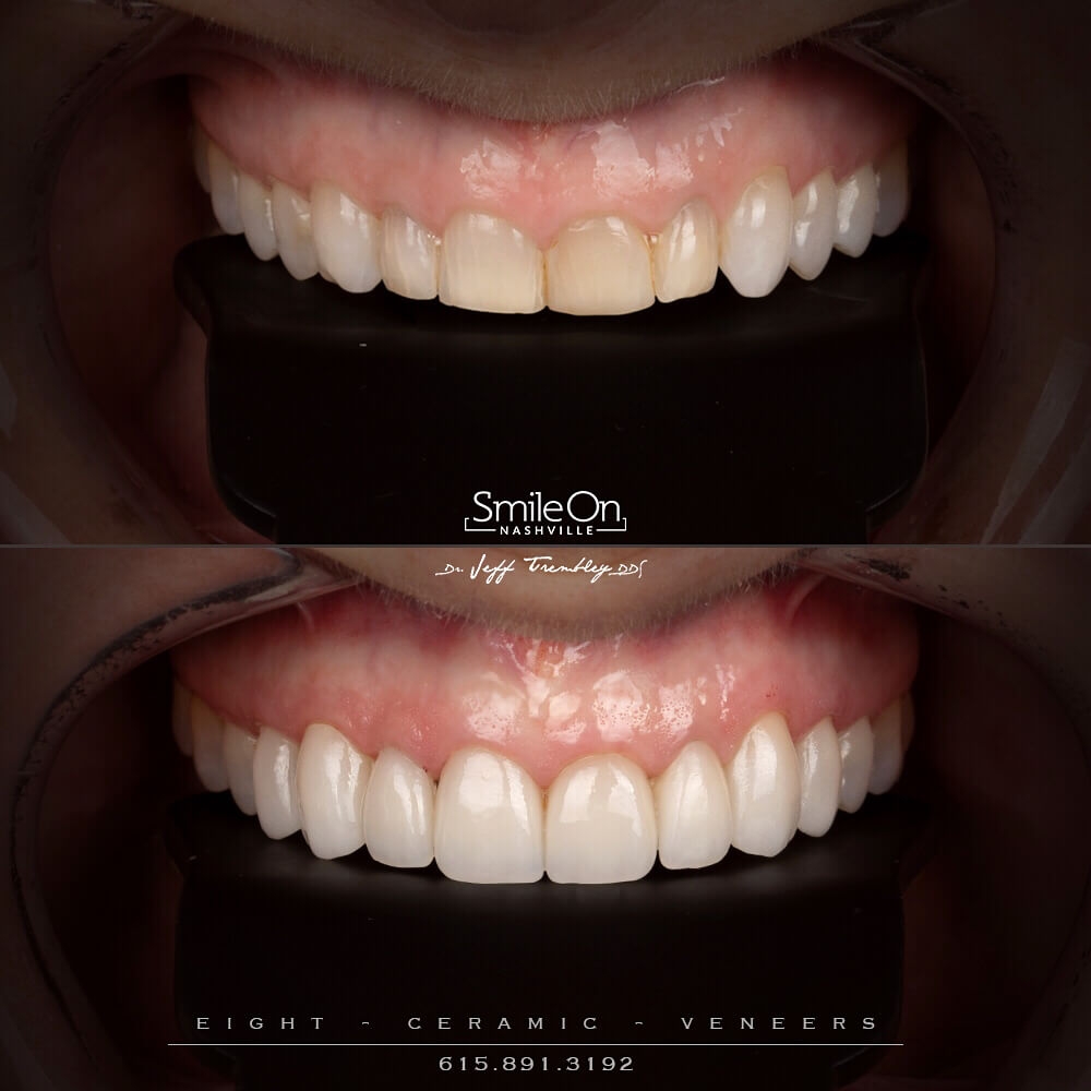 Eight-Veneers-by-Jeff-Trembley-and-Smile-On-Nashville