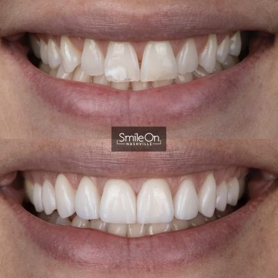 DrJeffTrembley-smileonnashville-cosmetic-dentistry-nashville-smileon-veneers-cleanings-01