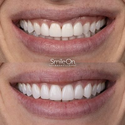 DrJeffTrembley-smileonnashville-cosmetic-dentistry-nashville-smileon-veneers-cleanings-02
