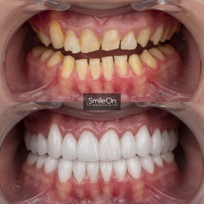 DrJeffTrembley-smileonnashville-cosmetic-dentistry-nashville-smileon-veneers-cleanings-04