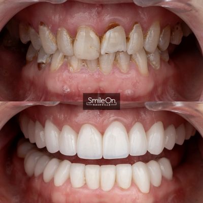 DrJeffTrembley-smileonnashville-cosmetic-dentistry-nashville-smileon-veneers-cleanings-07