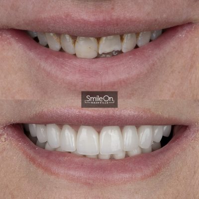 DrJeffTrembley-smileonnashville-cosmetic-dentistry-nashville-smileon-veneers-cleanings-08