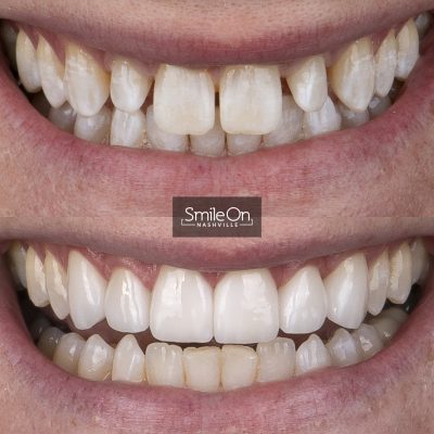 DrJeffTrembley-smileonnashville-cosmetic-dentistry-nashville-smileon-veneers-cleanings-10