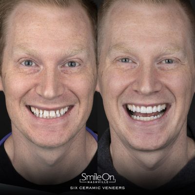DrJeffTrembley-smileonnashville-cosmetic-dentistry-nashville-smileon-veneers-cleanings-11