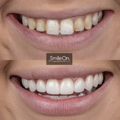 DrJeffTrembley-smileonnashville-cosmetic-dentistry-nashville-smileon-veneers-cleanings-14