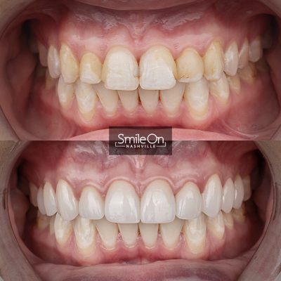 DrJeffTrembley-smileonnashville-cosmetic-dentistry-nashville-smileon-veneers-cleanings-15