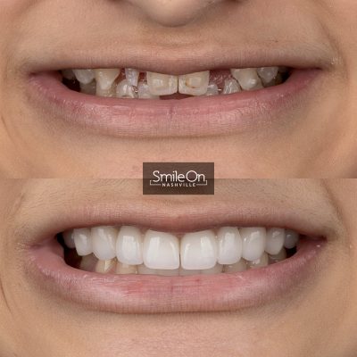 DrJeffTrembley-smileonnashville-cosmetic-dentistry-nashville-smileon-veneers-cleanings-16