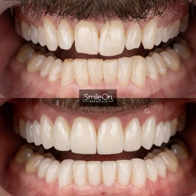 DrJeffTrembley-smileonnashville-cosmetic-dentistry-nashville-smileon-veneers-cleanings-17