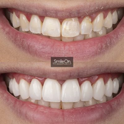 DrJeffTrembley-smileonnashville-cosmetic-dentistry-nashville-smileon-veneers-cleanings-19