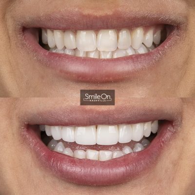 DrJeffTrembley-smileonnashville-cosmetic-dentistry-nashville-smileon-veneers-cleanings-21