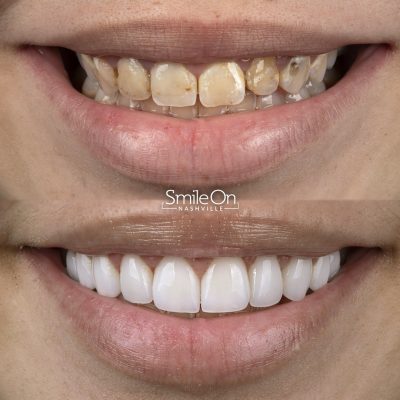 DrJeffTrembley-smileonnashville-cosmetic-dentistry-nashville-smileon-veneers-cleanings-23