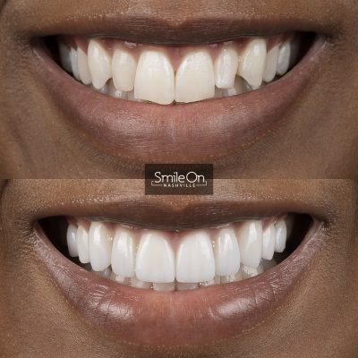 DrJeffTrembley-smileonnashville-cosmetic-dentistry-nashville-smileon-veneers-cleanings-25