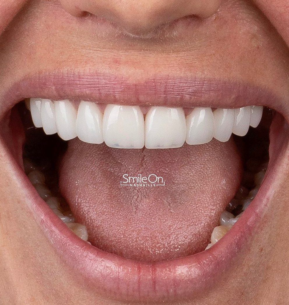 Ten Upper Veneers Smile On Nashville