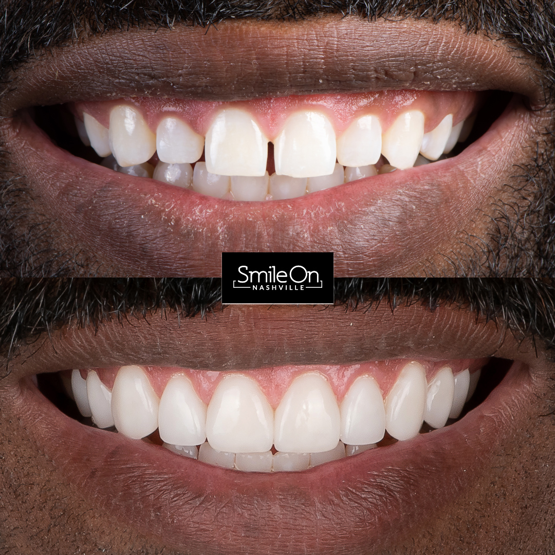 Surgical Crown Lengthening Smile On Nashville Surgical Crown Lengthening Smile On Nashville