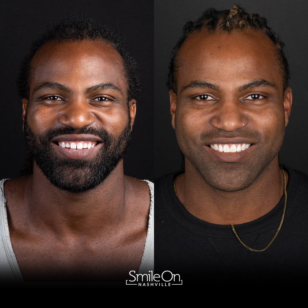 Surgical Crown Lengthening Smile On Nashville Surgical Crown Lengthening Smile On Nashville