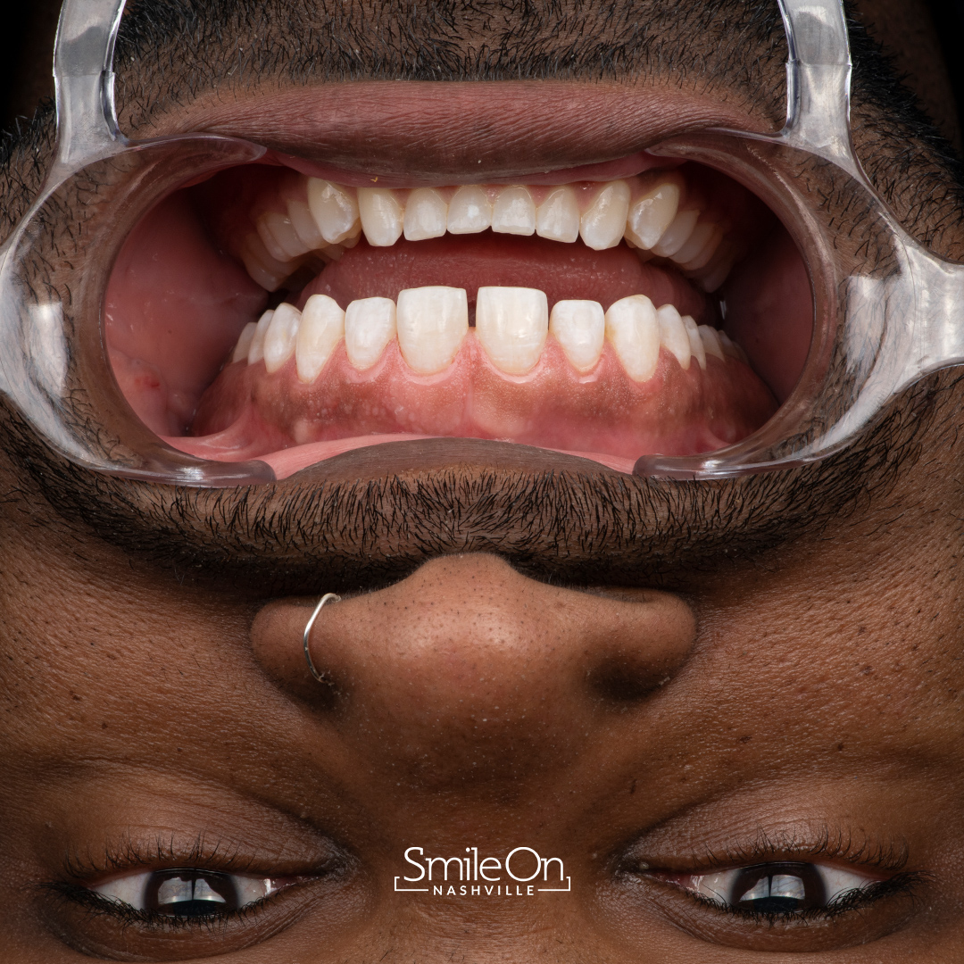 Surgical Crown Lengthening Smile On Nashville Surgical Crown Lengthening Smile On Nashville